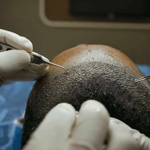 Close-up of a medical procedure showing a person's scalp during a hair transplant