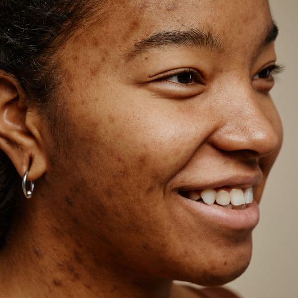 Close up image of a woman with acne scars on face