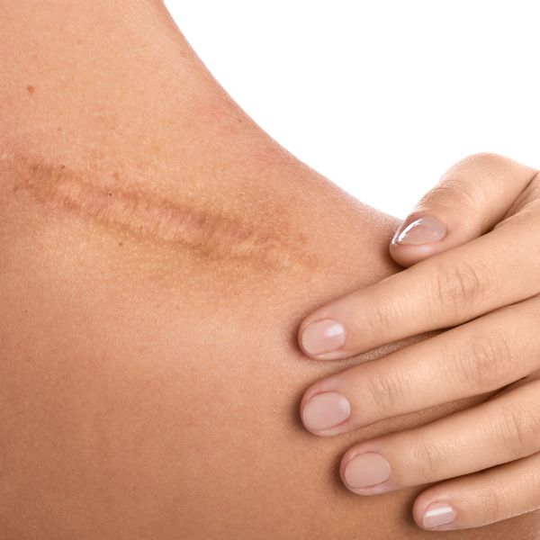 Close-up of a hand gently touching a scar on a person's shoulder